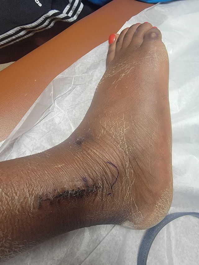 Photos of Tamila Glaze’s ankle injury. The former behavioral health associate at Metropolitan said she injured it while running away from a patient after breaking up a fight at the hospital on Mother’s Day 2019.
